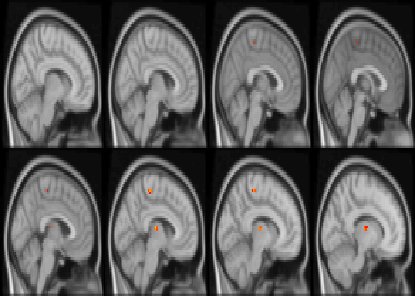 Diagnostic differences in fALFF controlling for sex, age, motion, and site. Colors are signed RESI values showing uncorrected $S \ge 0.1$. for slices `z=28:36`.