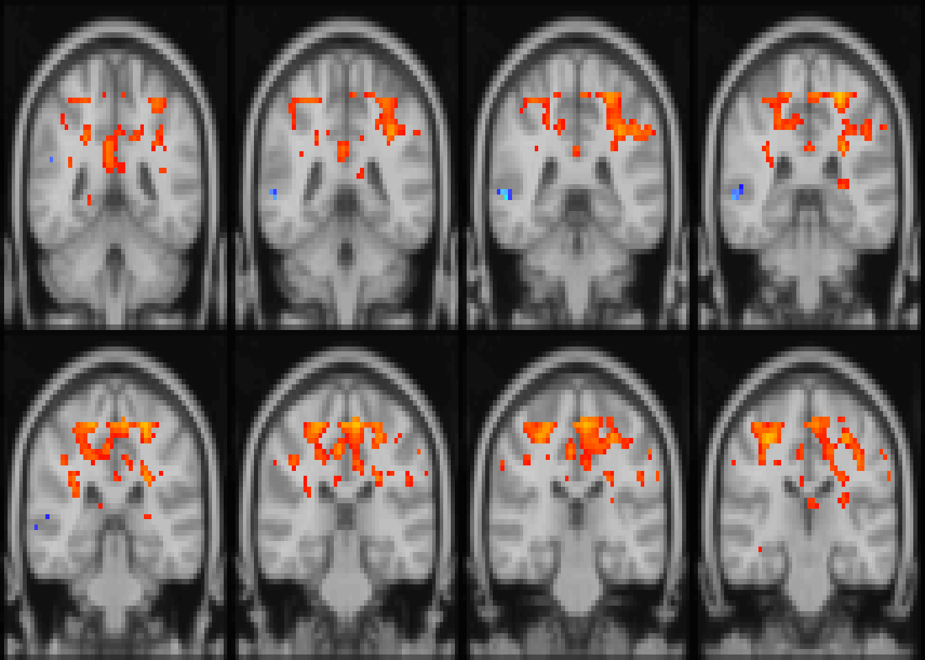 Diagnostic differences in fALFF controlling for sex, age, motion, and site. Colors are signed -log10(p) values showing uncorrected $p \le 0.05$. for slices `z=28:36`