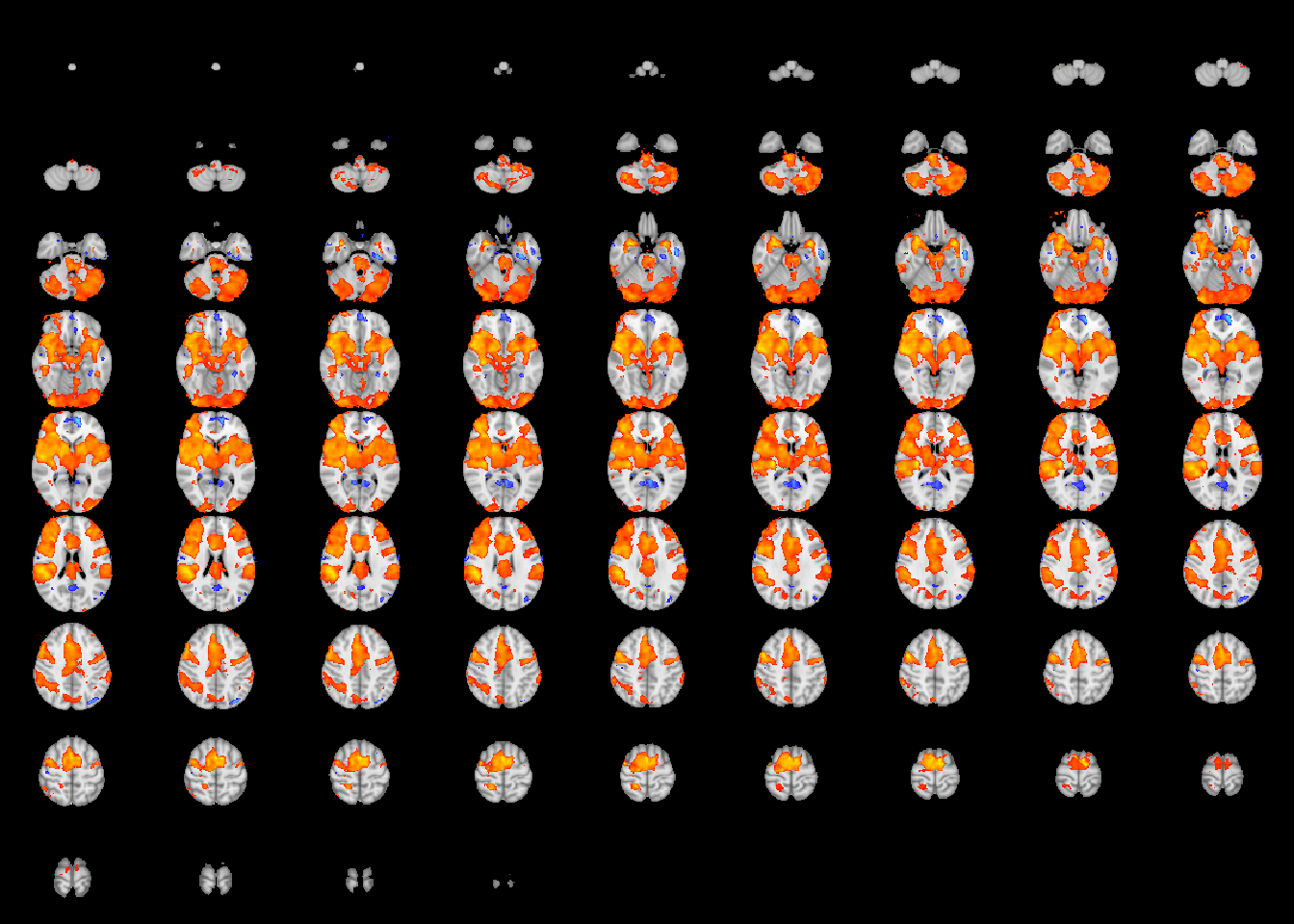 Effect size (top) and p-value (bottom) thresholding of the one-sample meta-analytic test of pain activation.