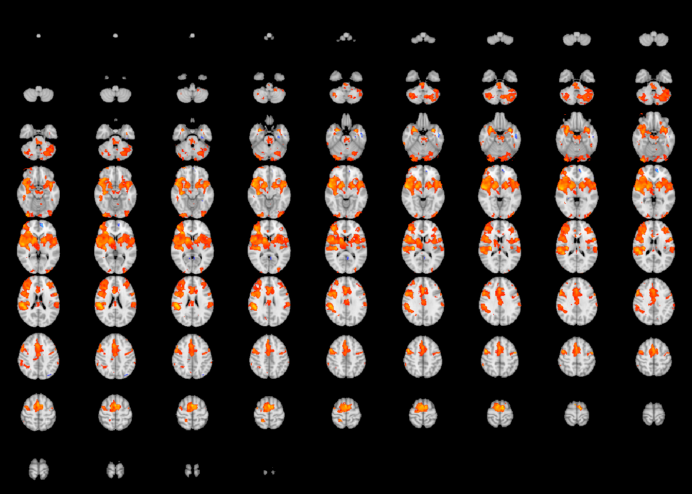 Effect size (top) and p-value (bottom) thresholding of the one-sample meta-analytic test of pain activation.